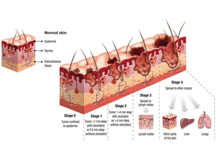 Wide Excision Melanoma Surgery Equinedesigners